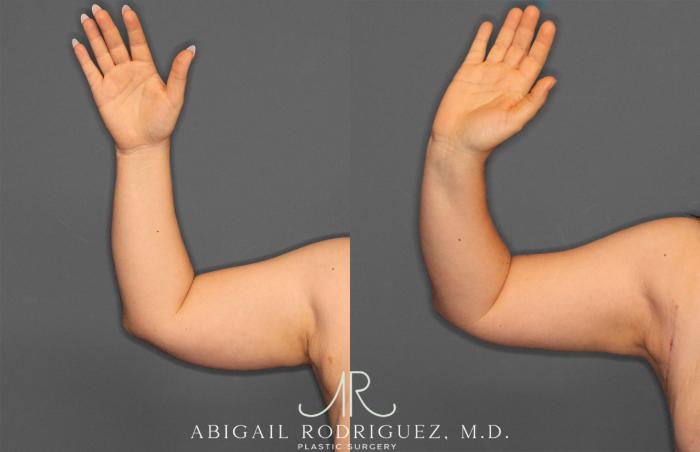 Before & After Arm Liposuction Case 257373 View 1 View in Houston, TX
