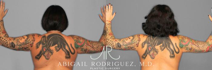 Before & After Arm Liposuction Case 258126 View 1 View in Houston, TX