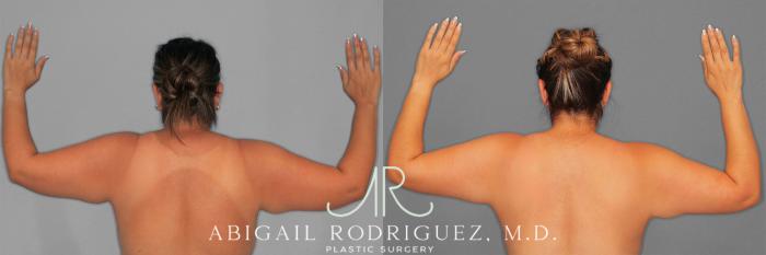 Before & After Arm Liposuction Case 258577 View 1 View in Houston, TX