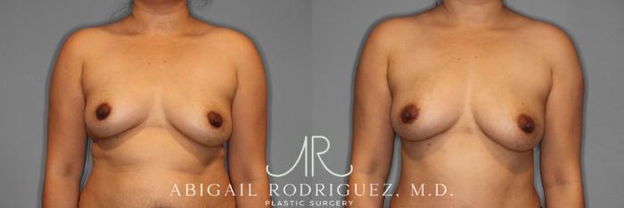 Before & After Breast Augmentation with Fat Grafting Case 345994 Front View in Houston, TX