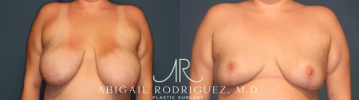 Before & After Breast Reduction Case 346005 Front View in Houston, TX