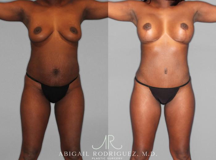 Before & After Mommy Makeover Case 253979 View 1 View in Houston, TX