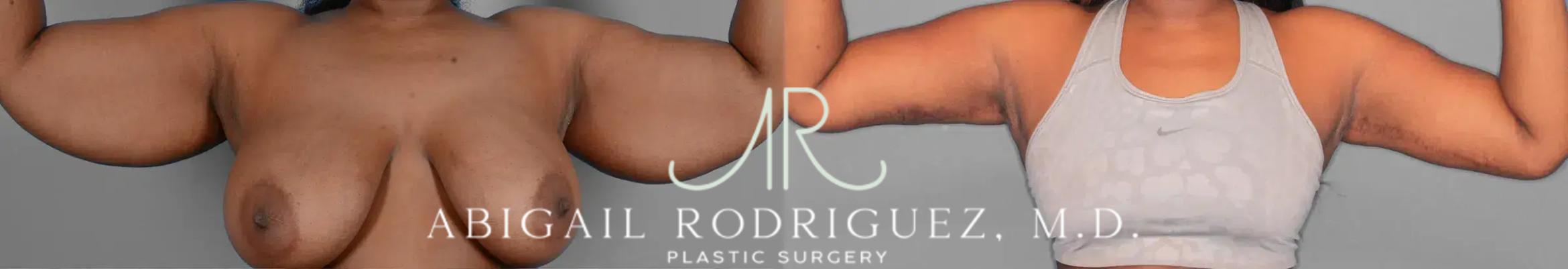 Before & After Arm Lift Case 259258 View 1 View in Houston, TX