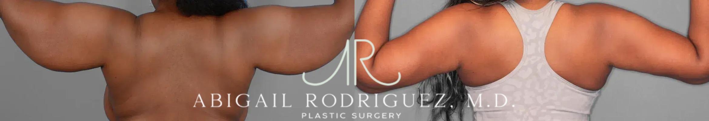 Before & After Arm Lift Case 259258 View 2 View in Houston, TX