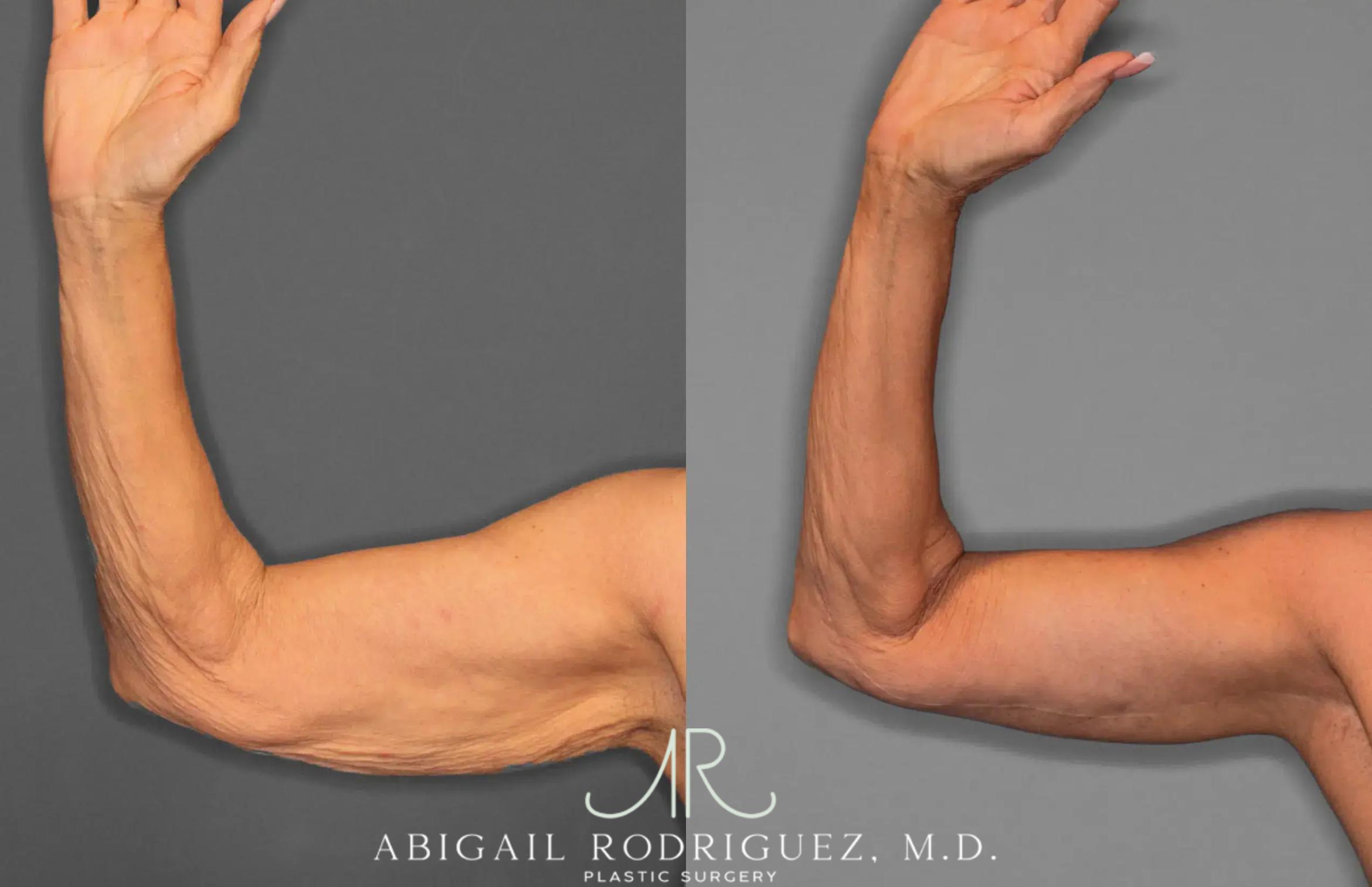 Before & After Arm Lift Case 259285 View 1 View in Houston, TX