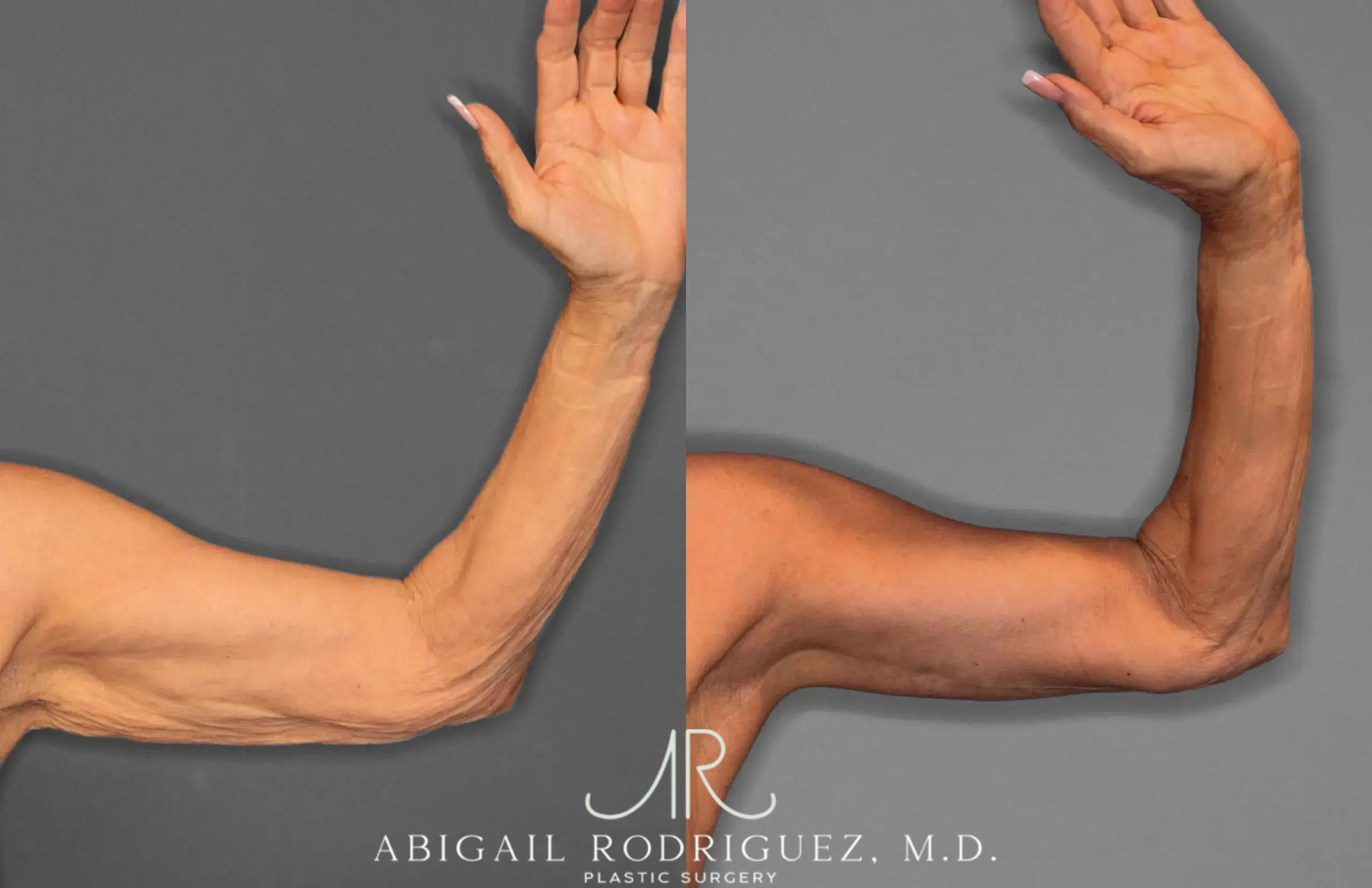 Before & After Arm Lift Case 259285 View 2 View in Houston, TX