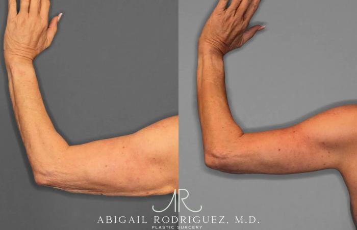 Before & After Arm Lift Case 259285 View 3 View in Houston, TX