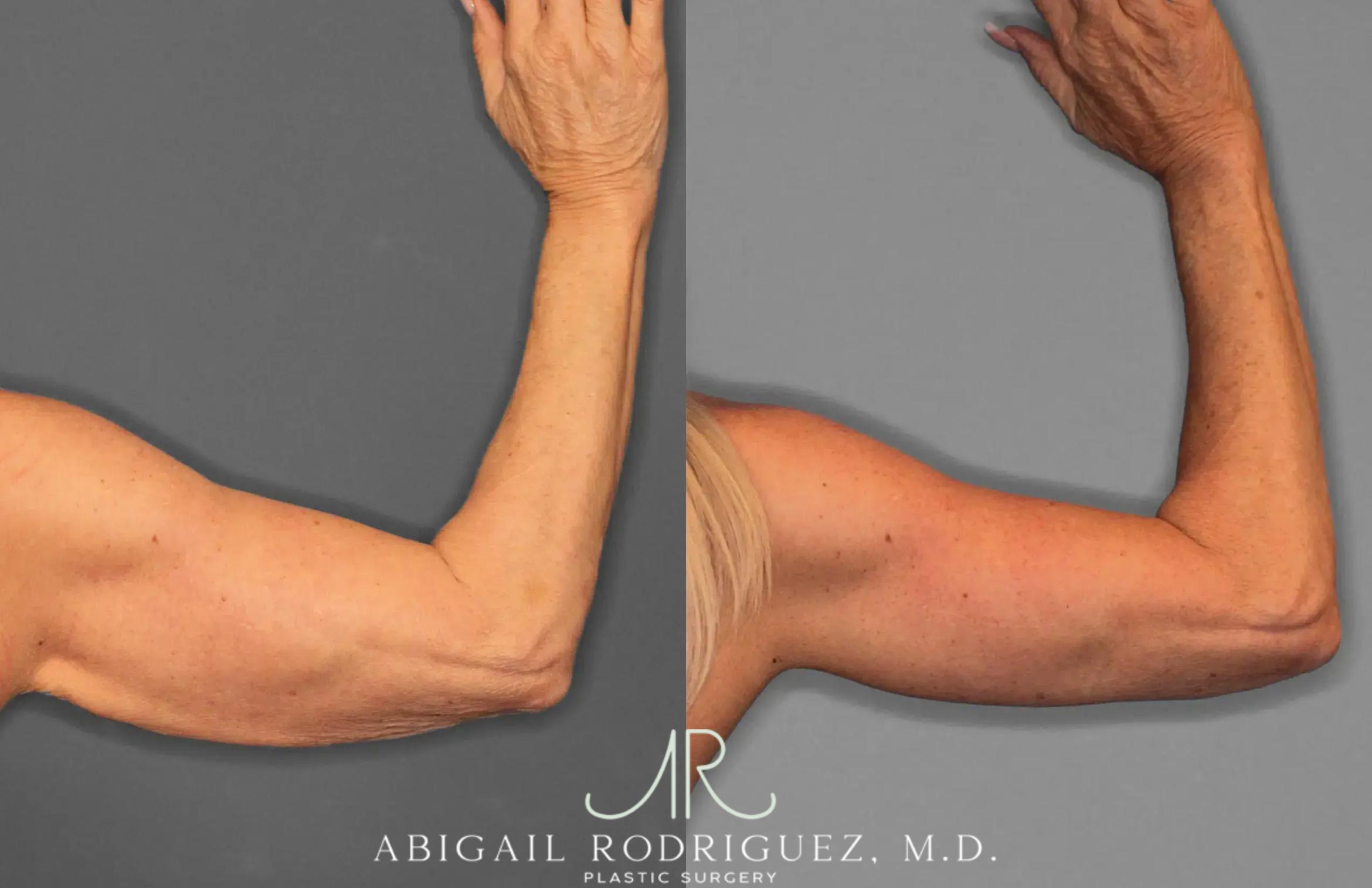 Before & After Arm Lift Case 259285 View 4 View in Houston, TX