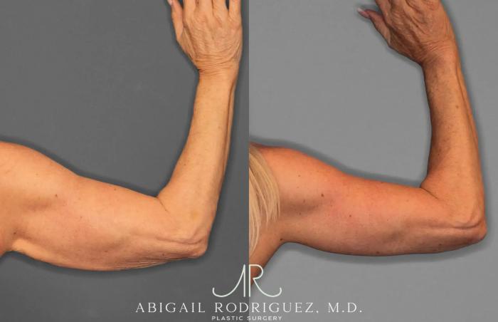 Before & After Arm Lift Case 259285 View 4 View in Houston, TX