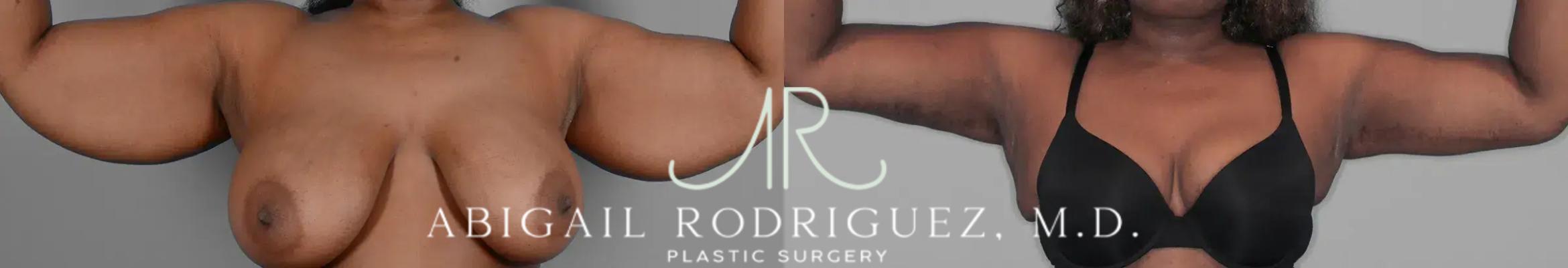 Before & After Arm Lift Case 259385 View 1 View in Houston, TX