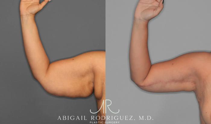 Before & After Arm Lift Case 259421 View 3 View in Houston, TX