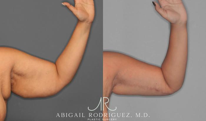 Before & After Arm Lift Case 259421 View 4 View in Houston, TX