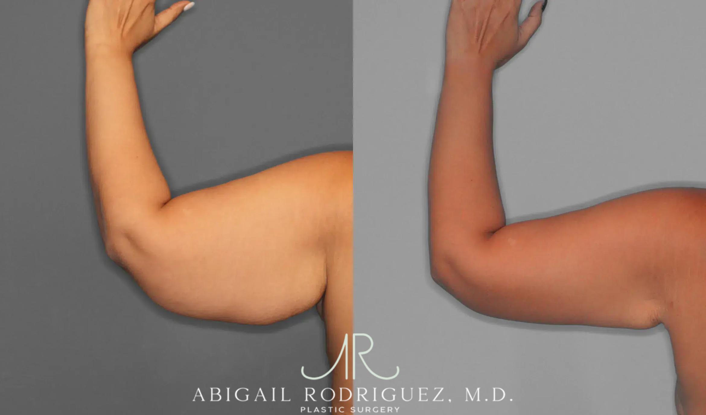Before & After Arm Lift Case 259421 View 5 View in Houston, TX