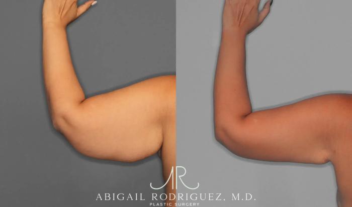 Before & After Arm Lift Case 259421 View 5 View in Houston, TX
