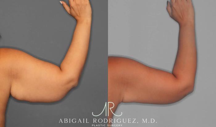 Before & After Arm Lift Case 259421 View 6 View in Houston, TX