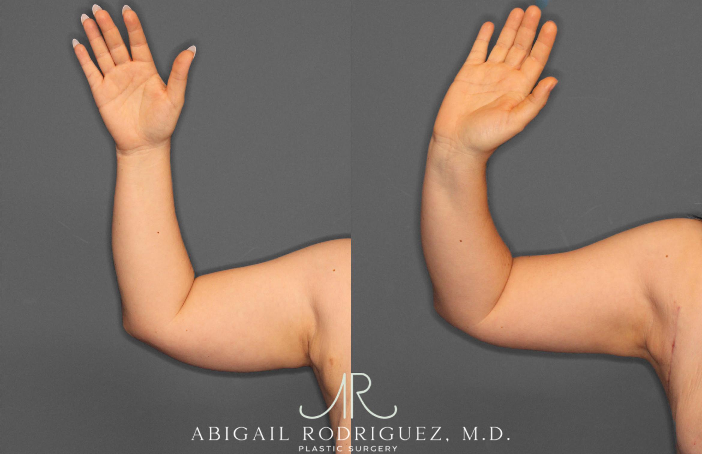 Before & After Arm Liposuction Case 257373 View 1 View in Houston, TX