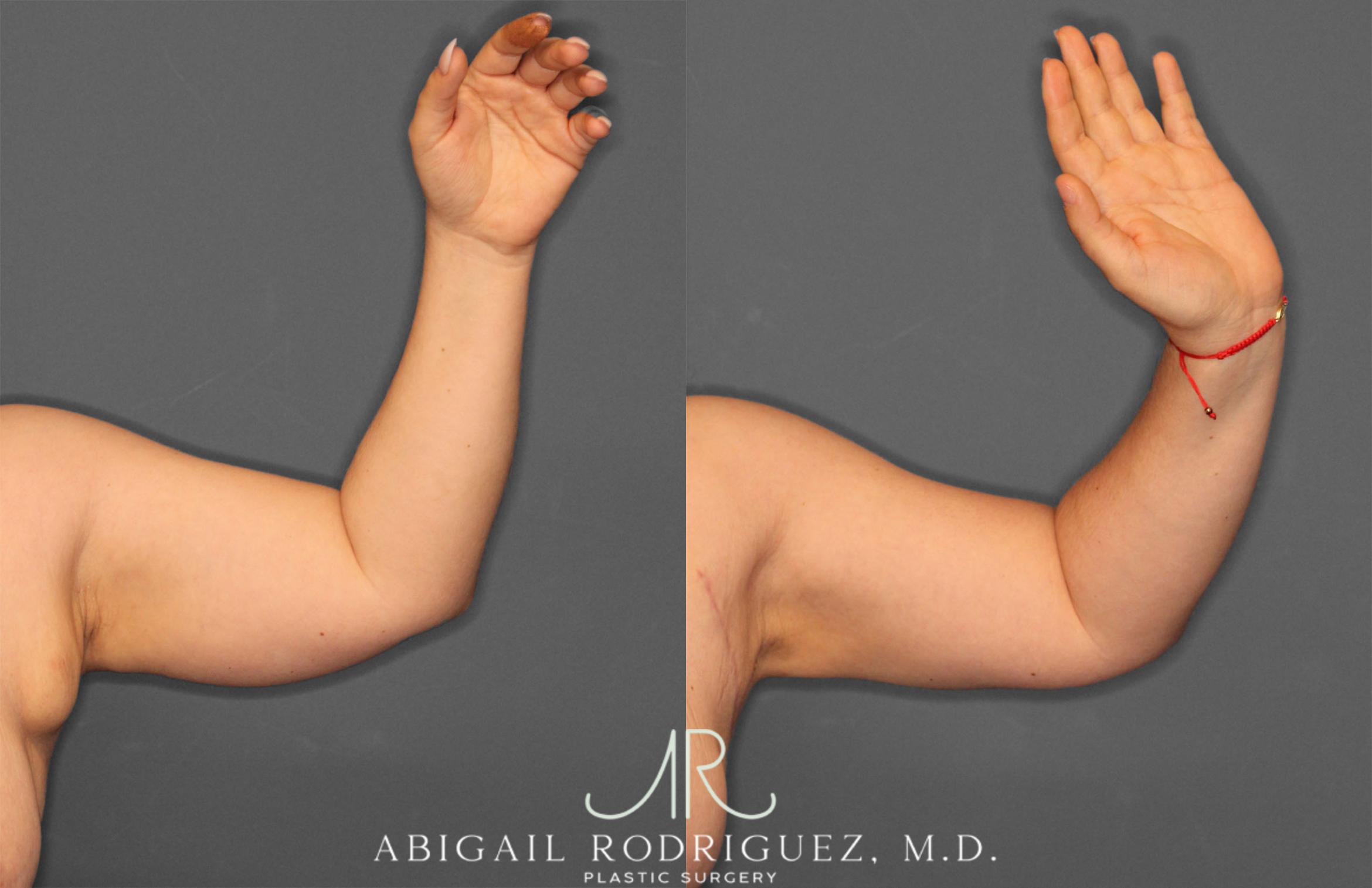 Before & After Arm Liposuction Case 257373 View 2 View in Houston, TX