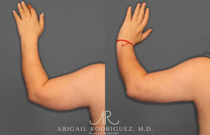 Before & After Arm Liposuction Case 257373 View 3 View in Houston, TX