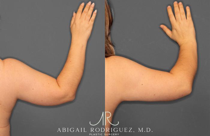 Before & After Arm Liposuction Case 257373 View 4 View in Houston, TX