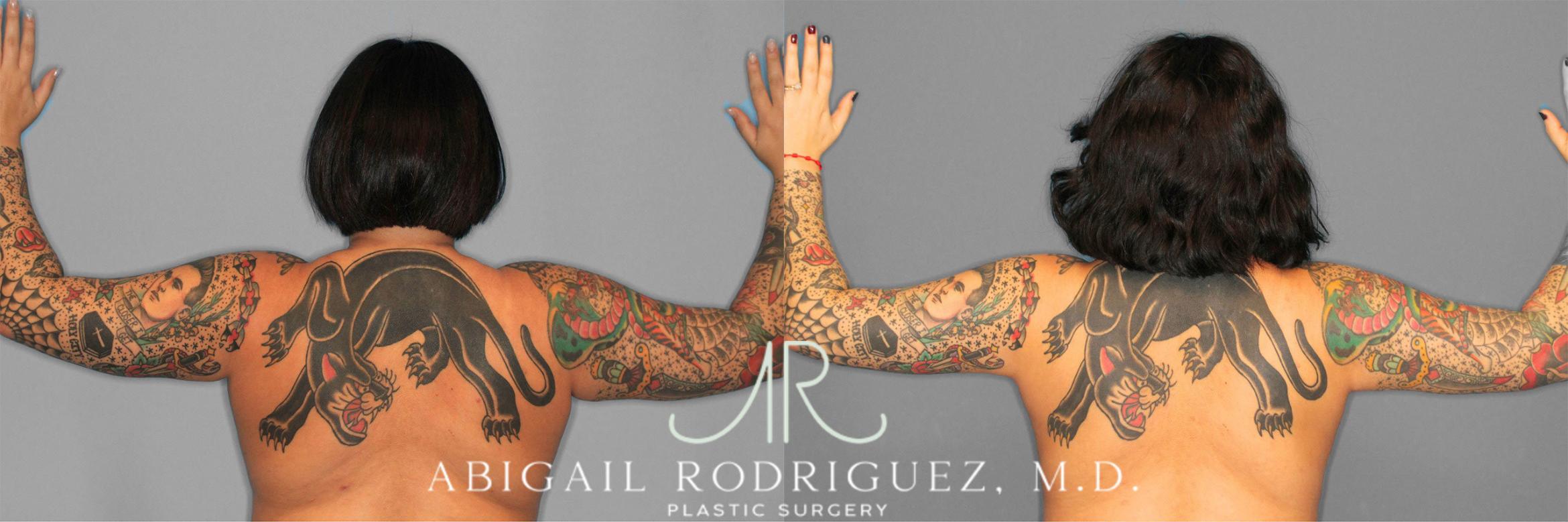 Before & After Arm Liposuction Case 258126 View 1 View in Houston, TX