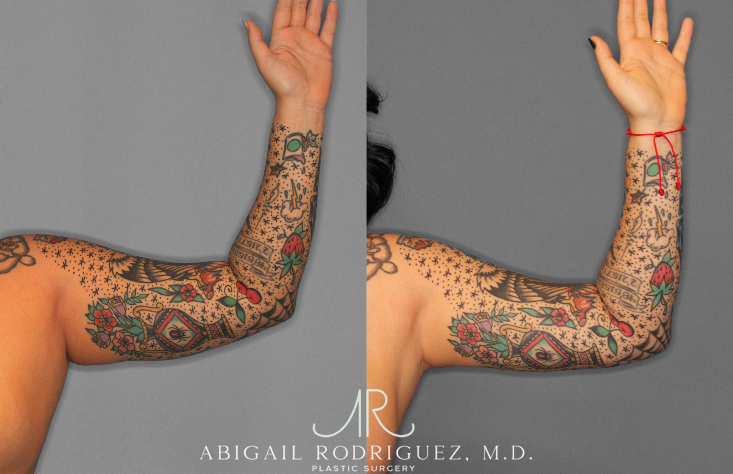 Before & After Arm Liposuction Case 258126 View 2 View in Houston, TX