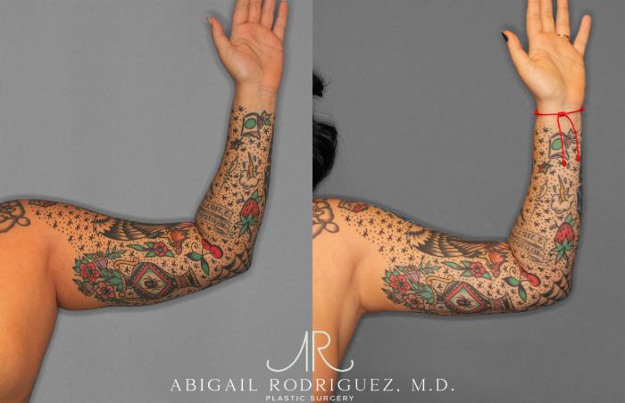 Before & After Arm Liposuction Case 258126 View 2 View in Houston, TX