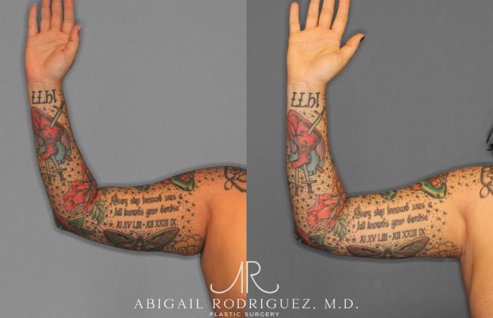 Before & After Arm Liposuction Case 258126 View 3 View in Houston, TX