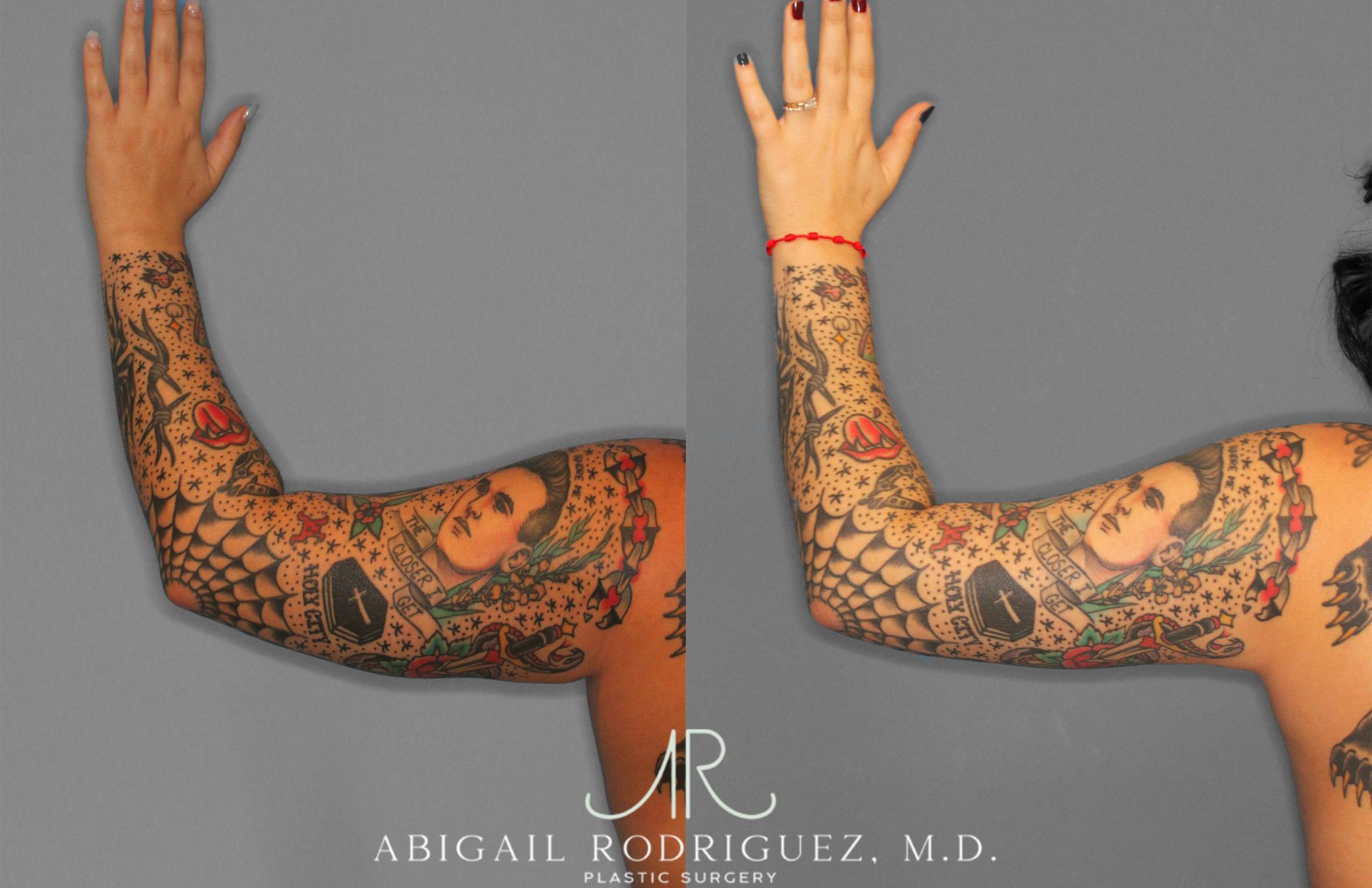 Before & After Arm Liposuction Case 258126 View 4 View in Houston, TX