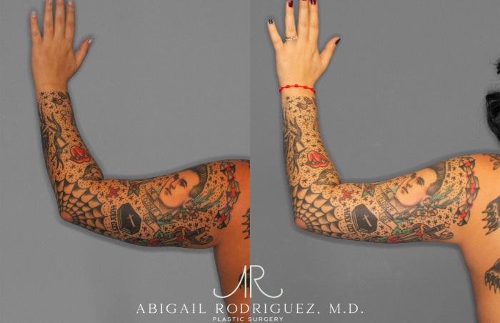 Before & After Arm Liposuction Case 258126 View 4 View in Houston, TX