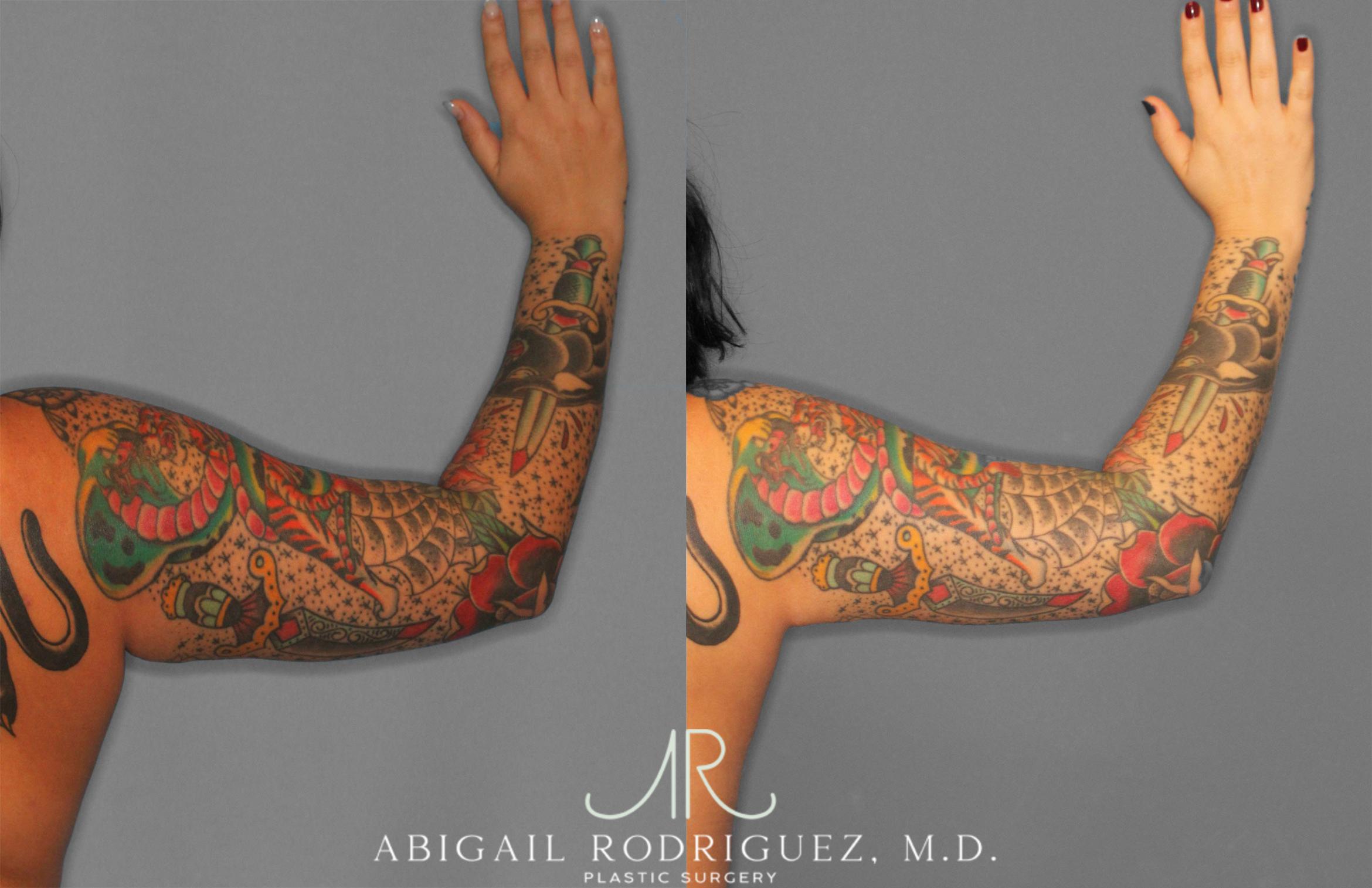Before & After Arm Liposuction Case 258126 View 5 View in Houston, TX