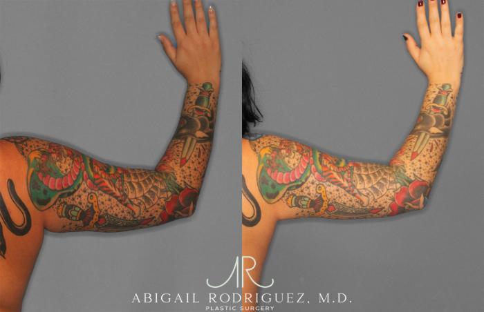Before & After Arm Liposuction Case 258126 View 5 View in Houston, TX