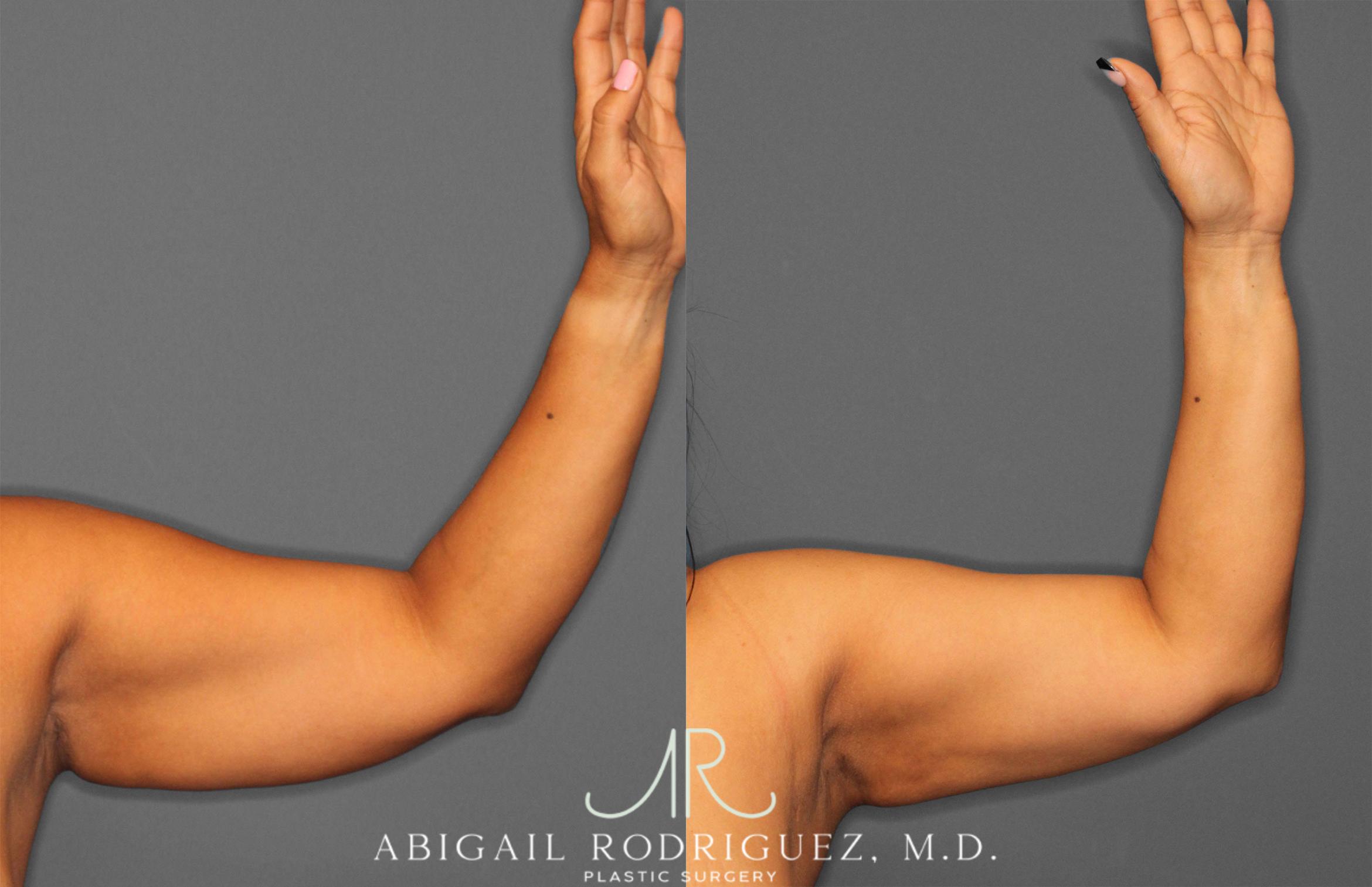 Before & After Arm Liposuction Case 258148 View 2 View in Houston, TX