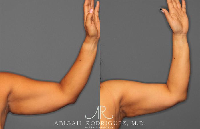 Before & After Arm Liposuction Case 258148 View 2 View in Houston, TX