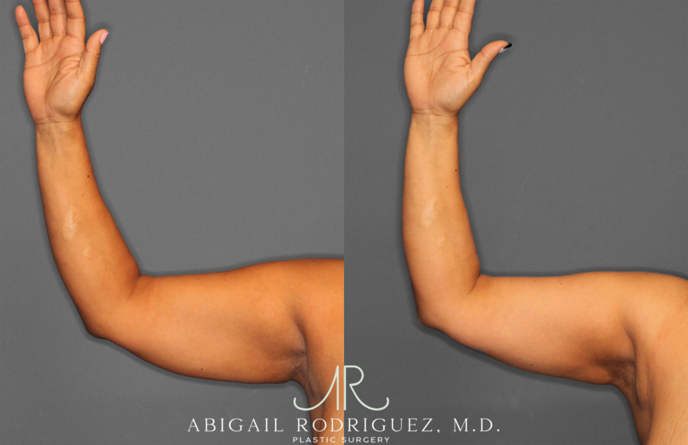 Before & After Arm Liposuction Case 258148 View 3 View in Houston, TX