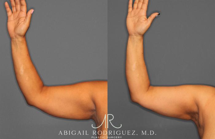 Before & After Arm Liposuction Case 258148 View 3 View in Houston, TX