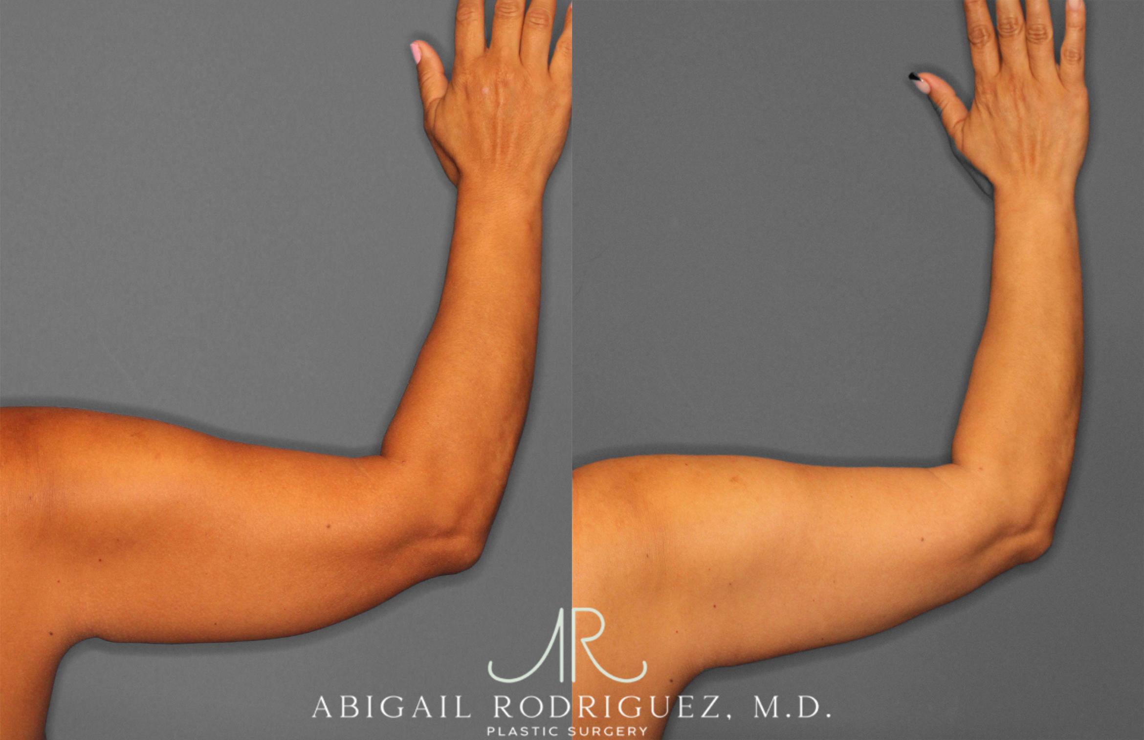 Before & After Arm Liposuction Case 258148 View 4 View in Houston, TX