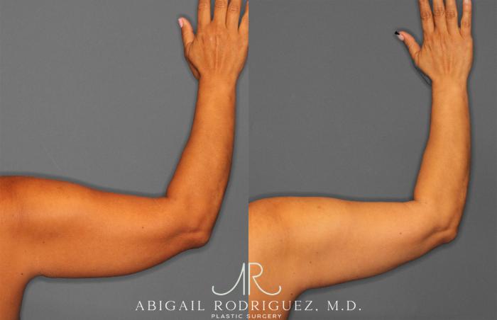 Before & After Arm Liposuction Case 258148 View 4 View in Houston, TX