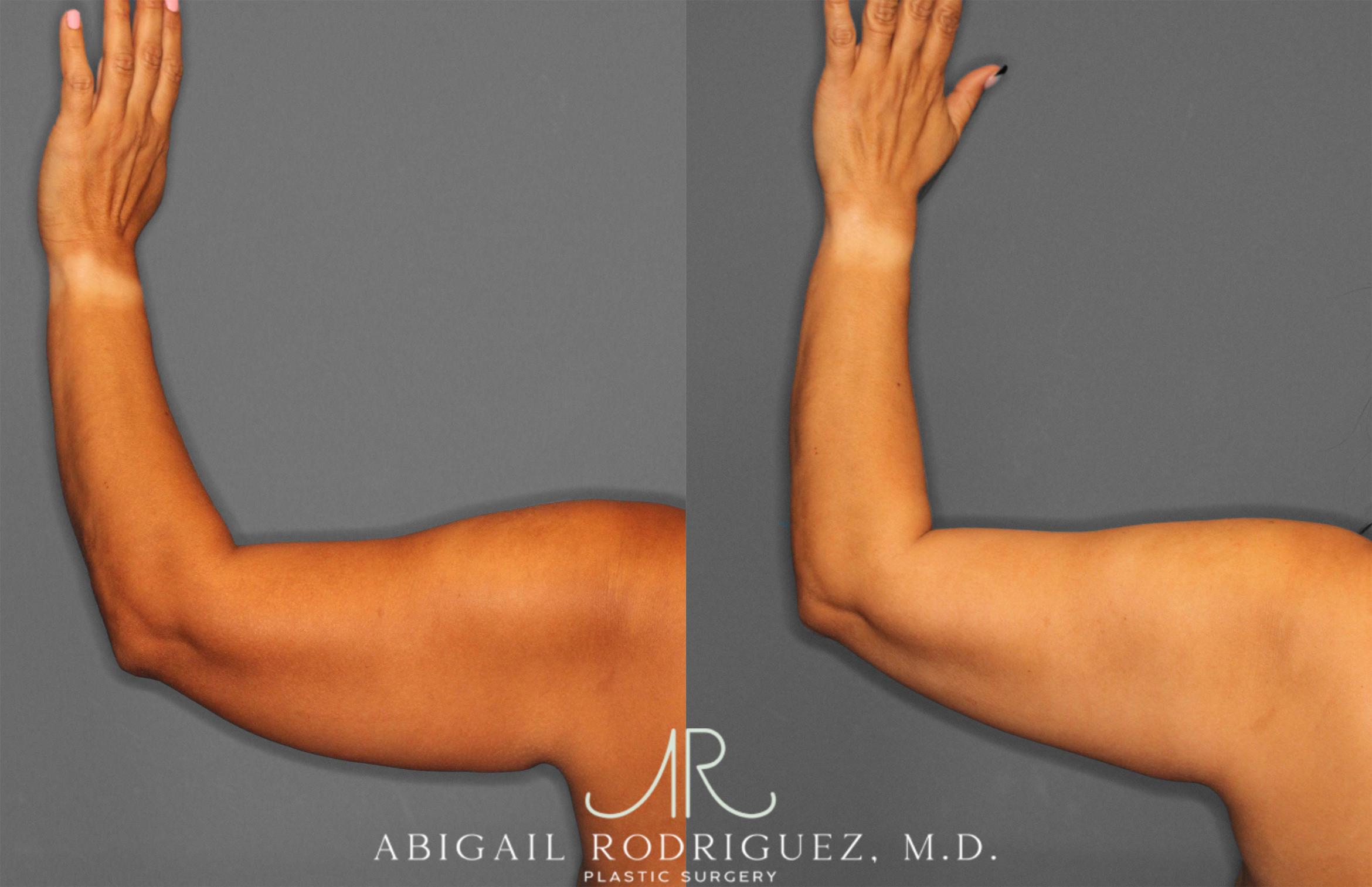 Before & After Arm Liposuction Case 258148 View 5 View in Houston, TX