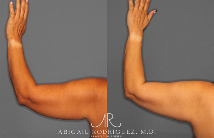 Before & After Arm Liposuction Case 258148 View 5 View in Houston, TX