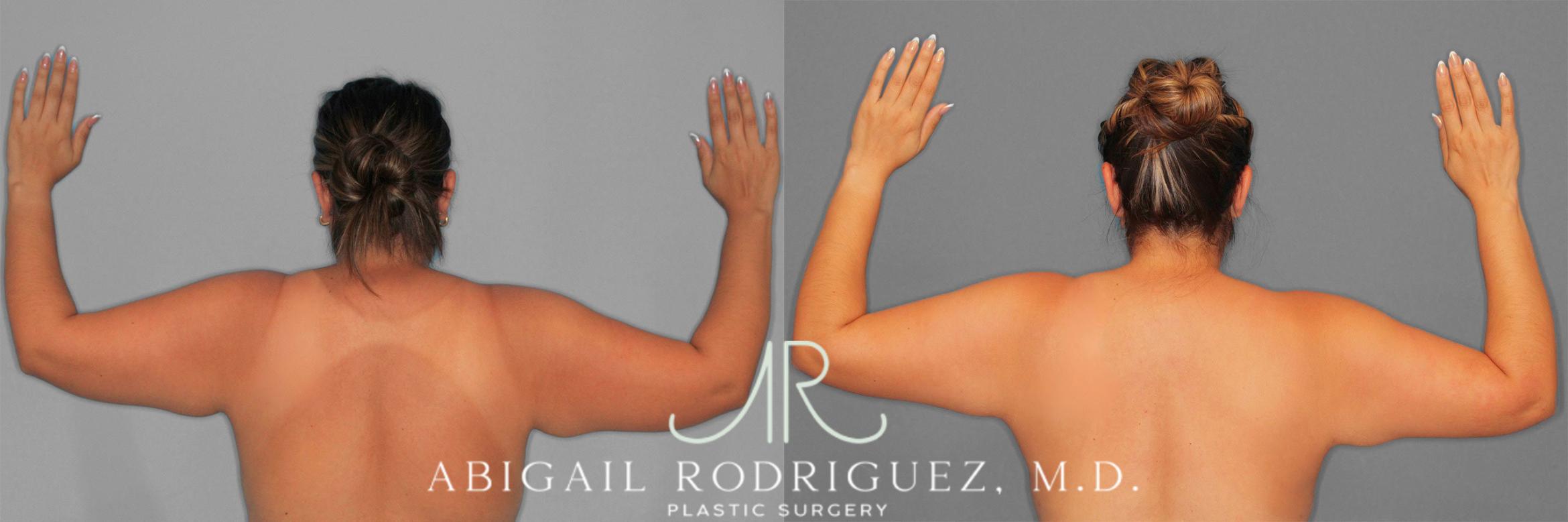 Before & After Arm Liposuction Case 258577 View 1 View in Houston, TX