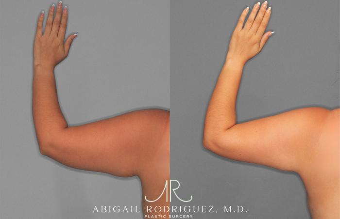 Before & After Arm Liposuction Case 258577 View 2 View in Houston, TX