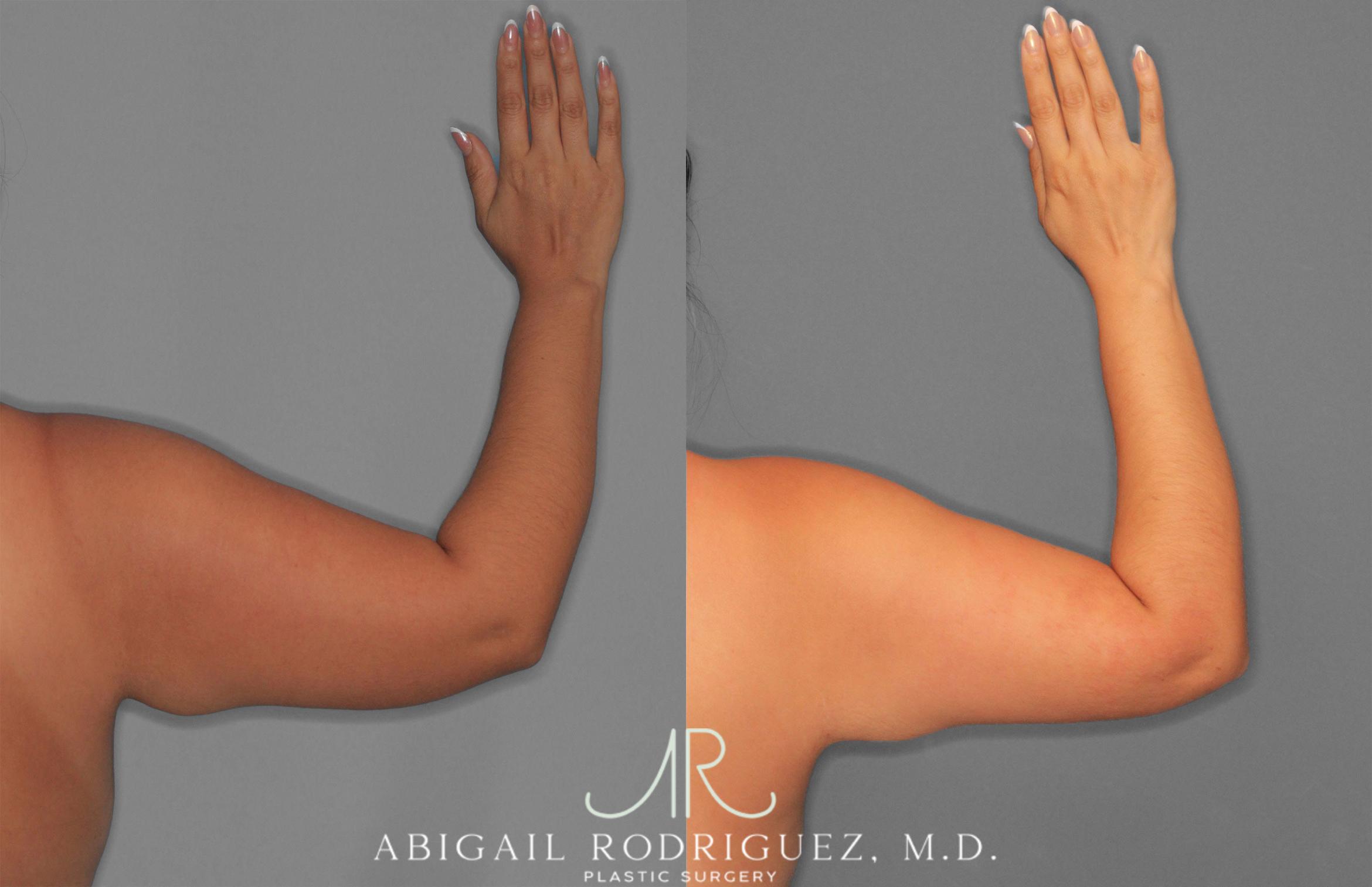 Before & After Arm Liposuction Case 258577 View 3 View in Houston, TX