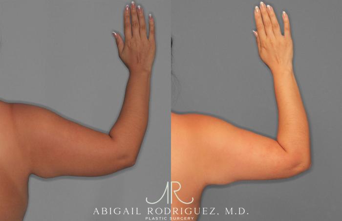 Before & After Arm Liposuction Case 258577 View 3 View in Houston, TX