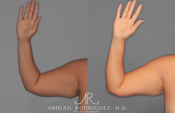 Before & After Arm Liposuction Case 258577 View 4 View in Houston, TX