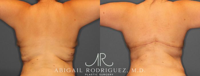 Before & After Bra Line Lift Case 254342 View 1 View in Houston, TX