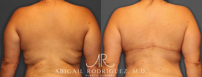 Before & After Bra Line Lift Case 254342 View 2 View in Houston, TX