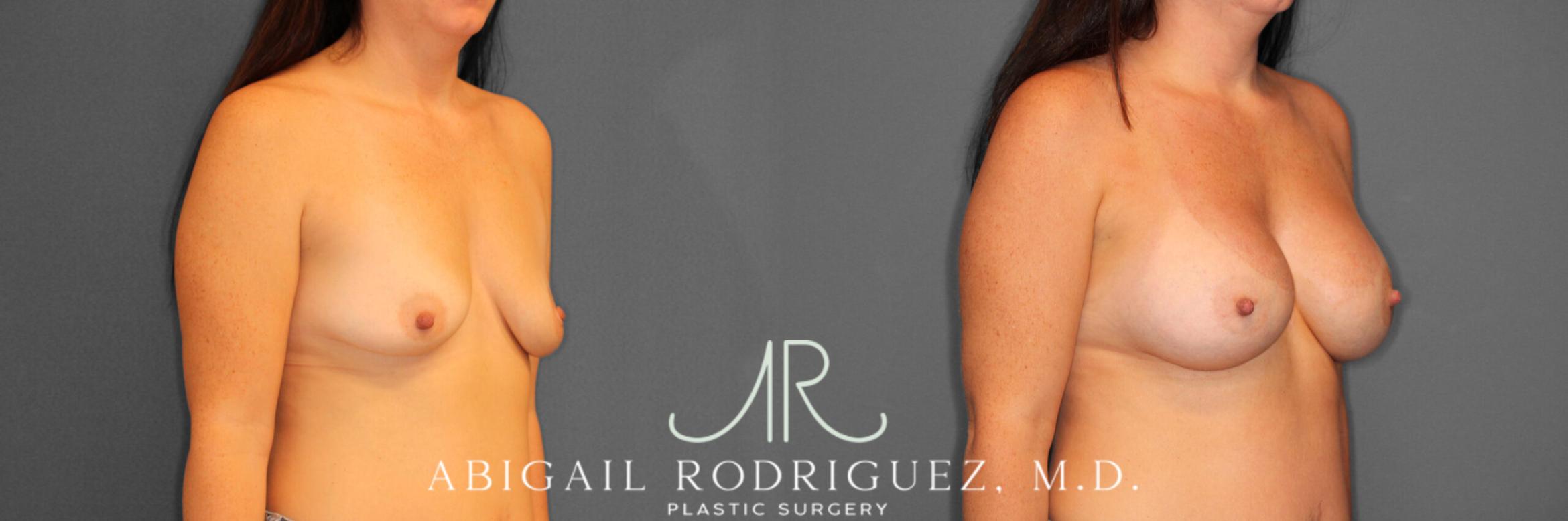 Before & After Breast Augmentation Case 253975 View 2 View in Houston, TX