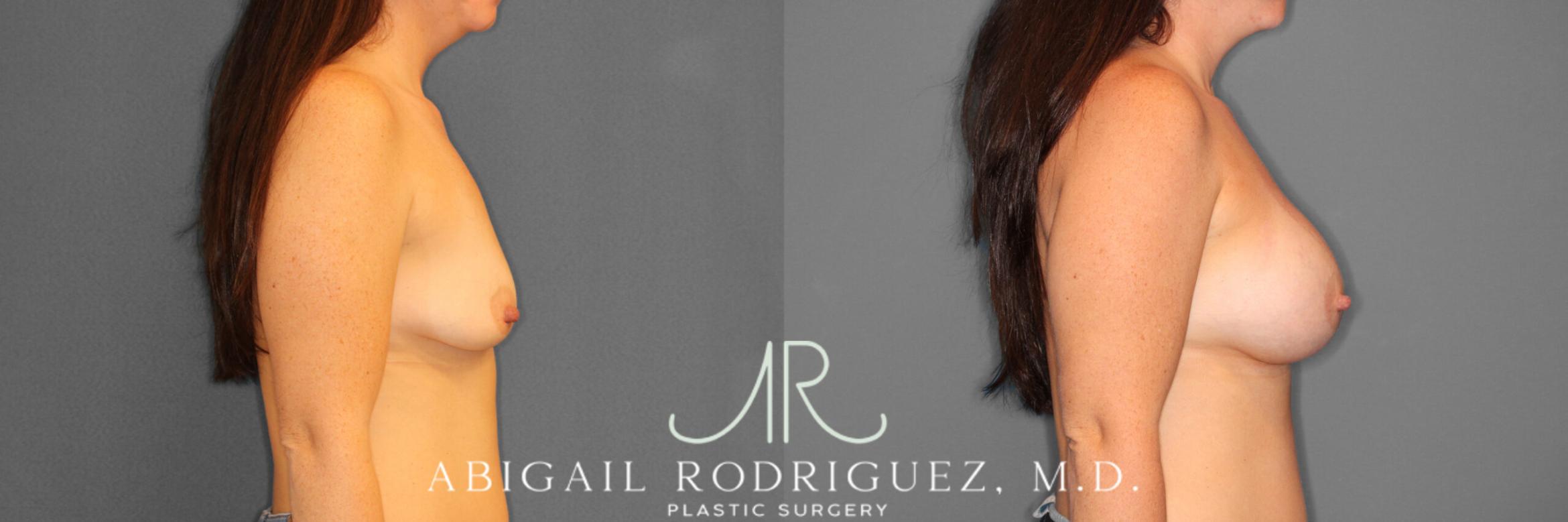 Before & After Breast Augmentation Case 253975 View 3 View in Houston, TX