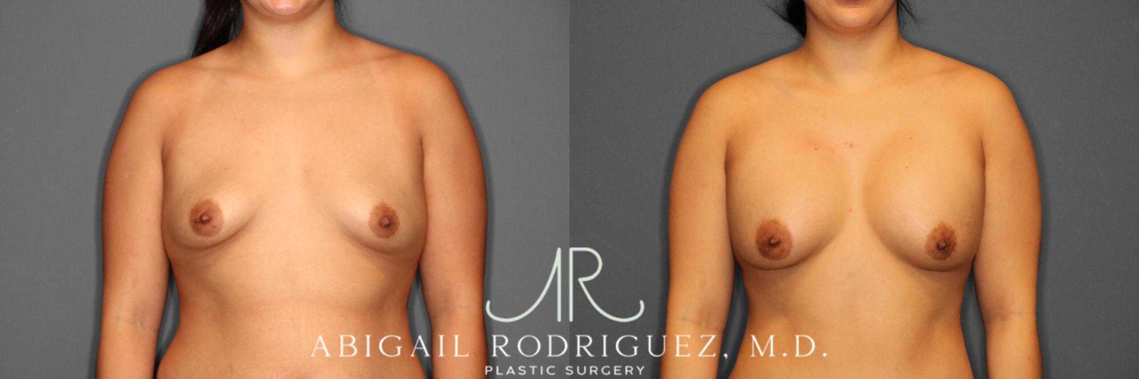 Before & After Breast Augmentation Case 254006 View 1 View in Houston, TX