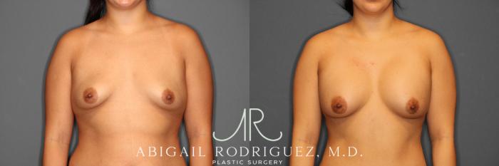 Before & After Breast Augmentation Case 254006 View 1 View in Houston, TX
